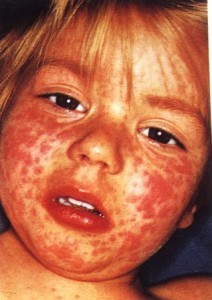 viral rash in children face