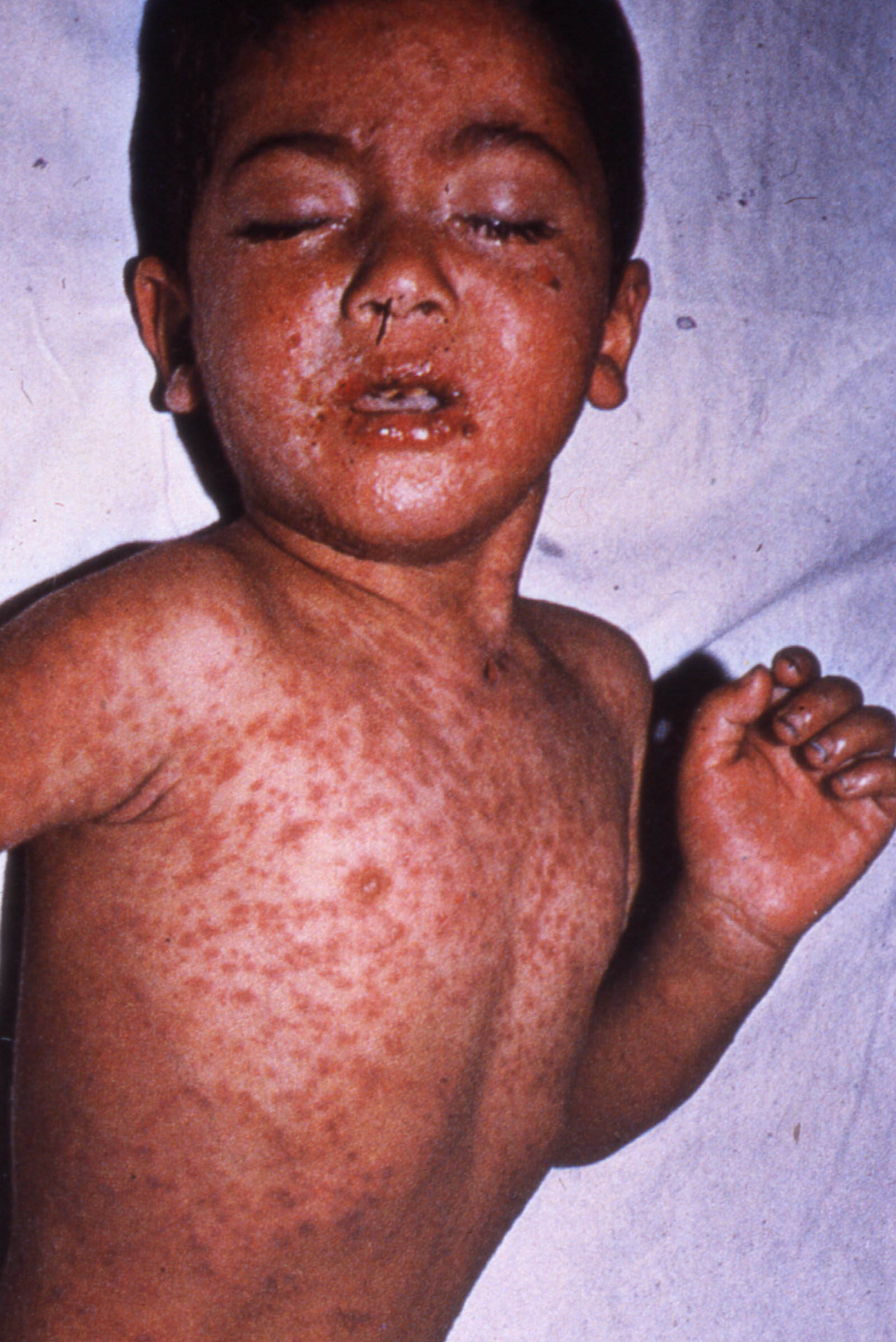 measles rash face