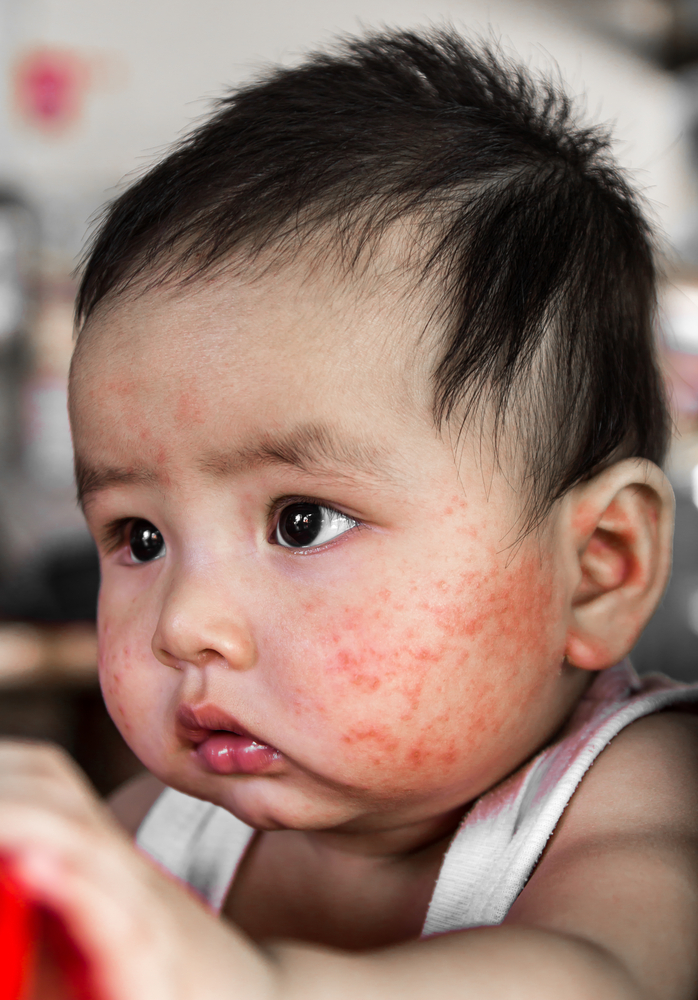 Can Dairy Cause Eczema In Babies