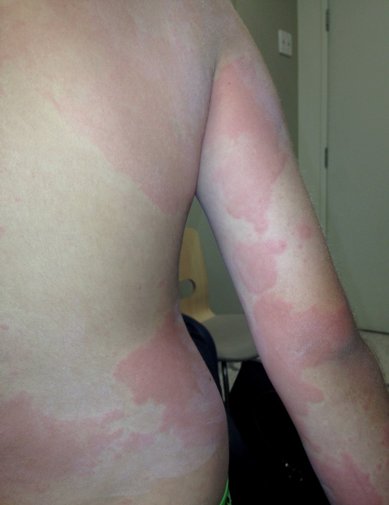 Uticarial Rash. Children Urticaria and Hives in children - Child Health